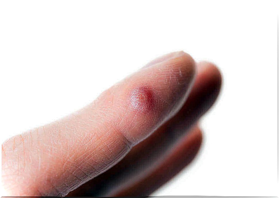 4 ways to remove warts from fingers