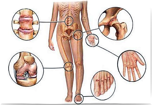 Inflammation of the joints