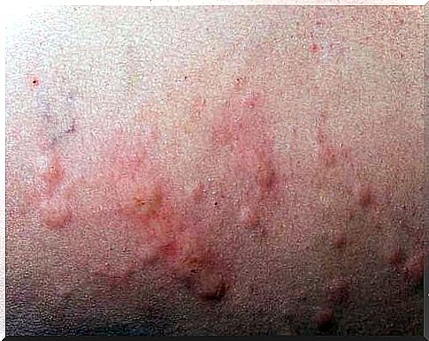 a rash is a symptom that your stress level is too high