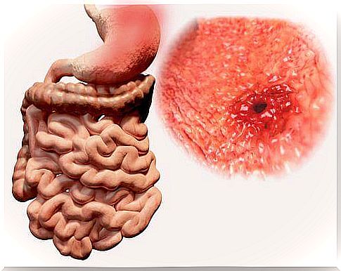 gastric ulcer