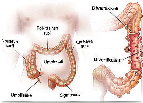 Diverticulitis and diverticulosis: diagnosis and treatment