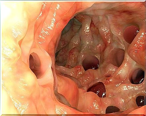 appendicitis on endoscopy