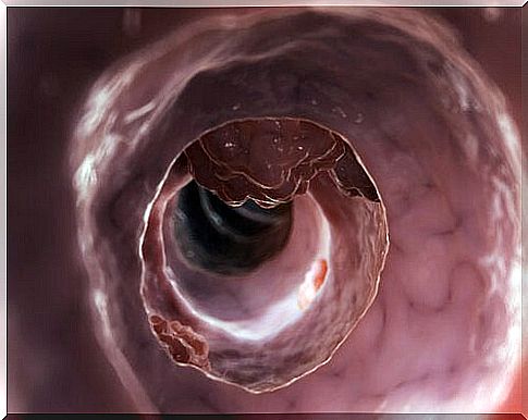 diverticulitis