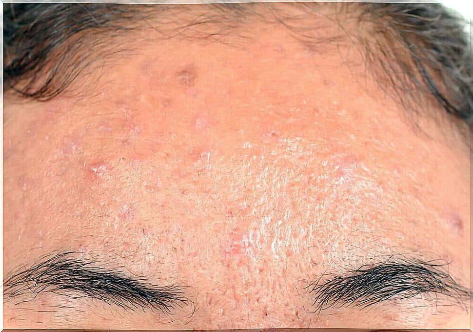 Effective natural treatments for sebum rash