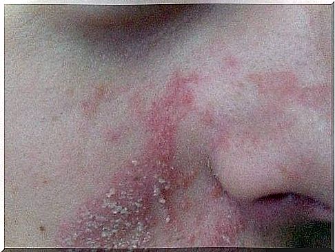 There are also natural treatments for sebum rash.