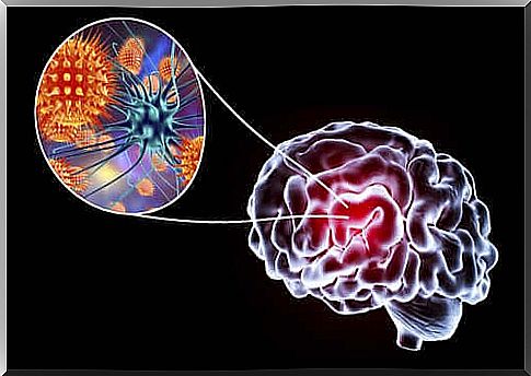 Encephalitis: symptoms, causes and treatment