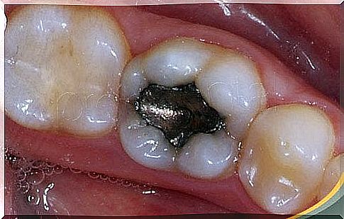 Health hazards of amalgam sites