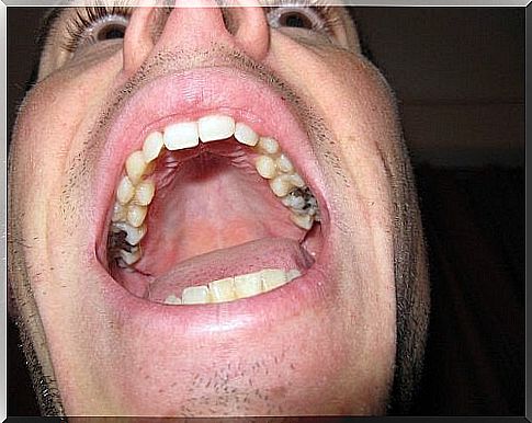 Amalgam spots in a man's mouth