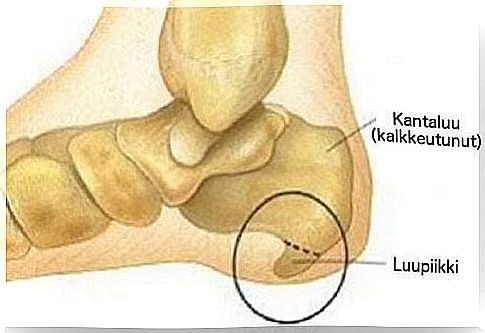 Heel spike: symptoms and treatment