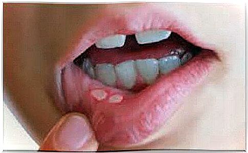 Prevention and treatment of oral blisters