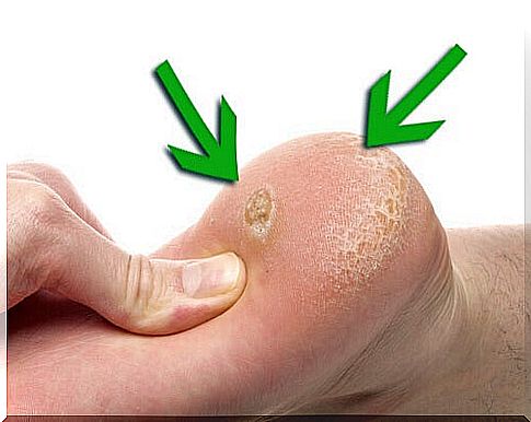 Removal of skin calluses by natural means