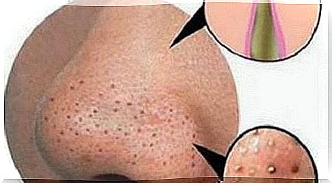 Remove pimples and blackheads by natural means