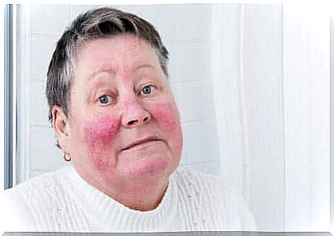 Rosacea: Causes, Symptoms and Treatment