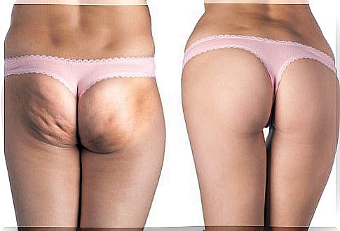 The best natural cellulite treatments