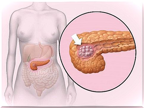 The symptoms of pancreatic cancer depend on the type of cancer