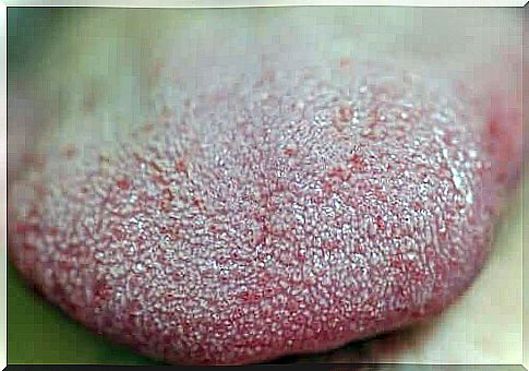 Dark spots on the tongue may be due to discoloration of the tongues