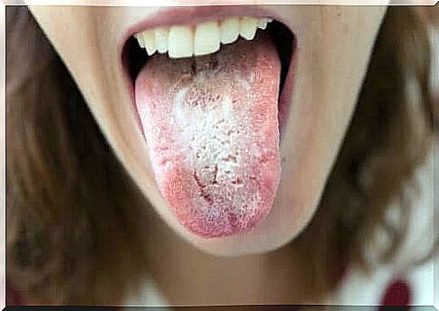 Black spots on the tongue can be caused by a fungal infection