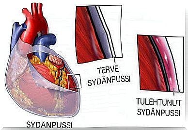 inflamed pericardium