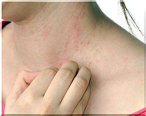 Atopic dermatitis manifests as pimples on the skin.