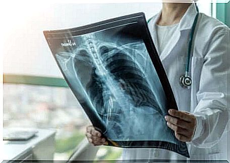 Latent pulmonary tuberculosis is detected by chance when examining other diseases