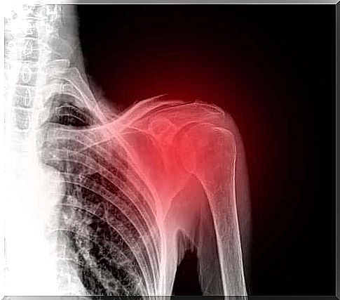 Ruptures of the rotator cuff are common in middle-aged people